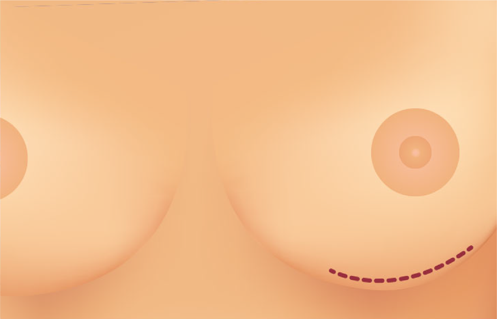 Motiva Incision Location PH