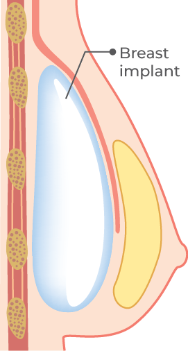Breast Implant Philippines