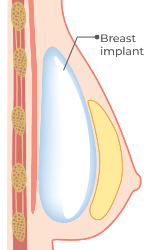 Breast Implant Philippines