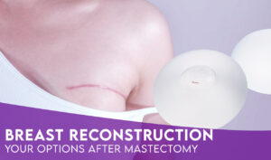 Breast Reconstruction After Mastectomy: Options for the Best Surgical Procedure
