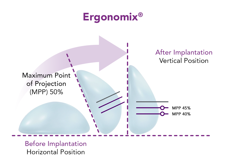 Breast Augmentation(Cohesive Gel)/ Tear Drop-Shaped (VG)